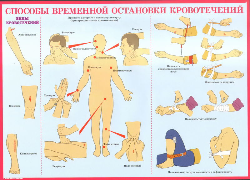 Способы временной остановки кровотечений Способы временной остановки кровотечений