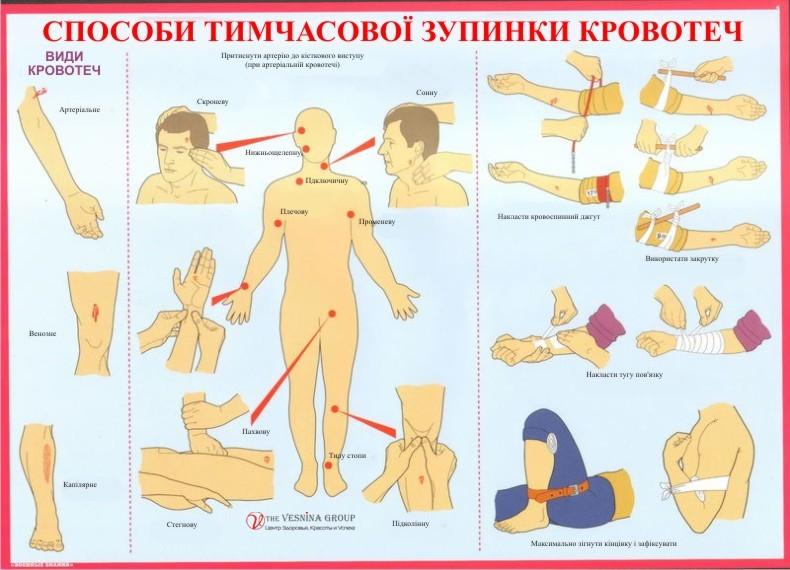 Способи тимчасової зупинки кровотеч Способи тимчасової зупинки кровотеч