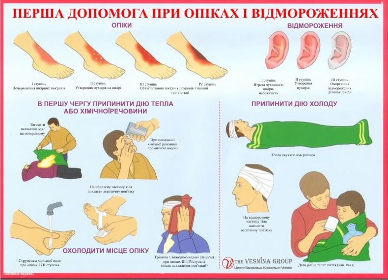 Перша допомога при опіках та відмороженнях Перша допомога при опіках та відмороженнях