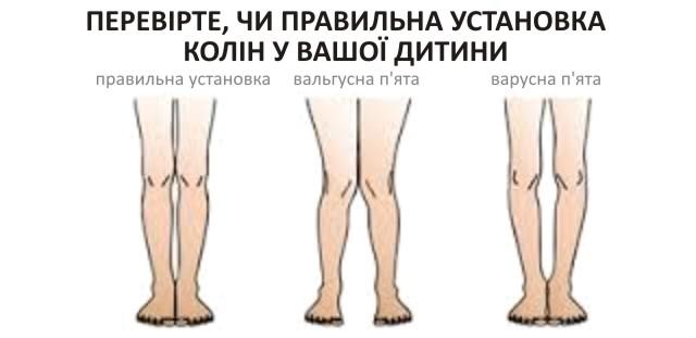 Правильна установка колін у дитини