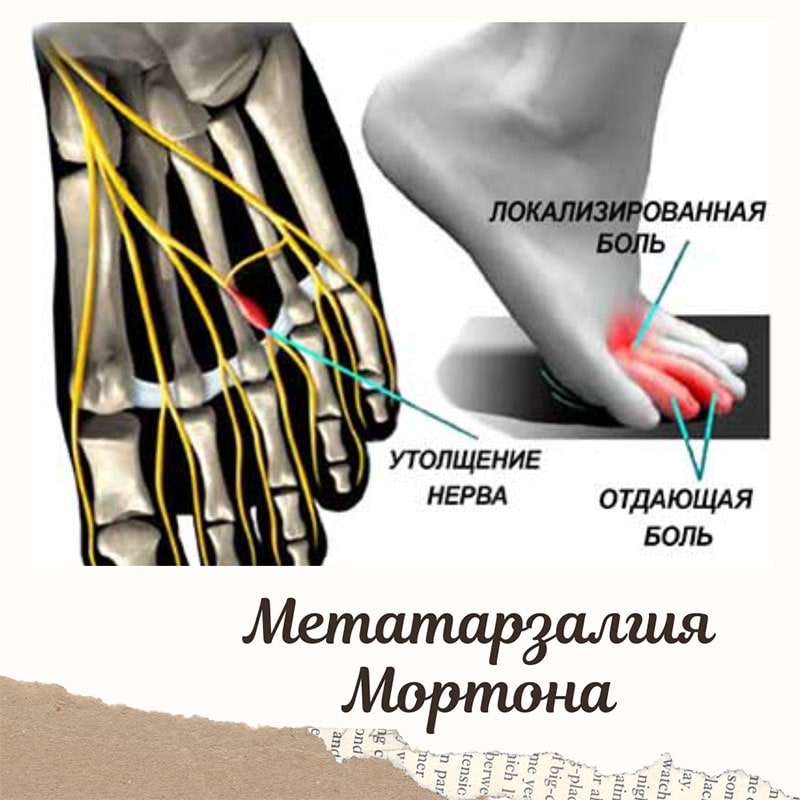 Метатарзалгия Мортона