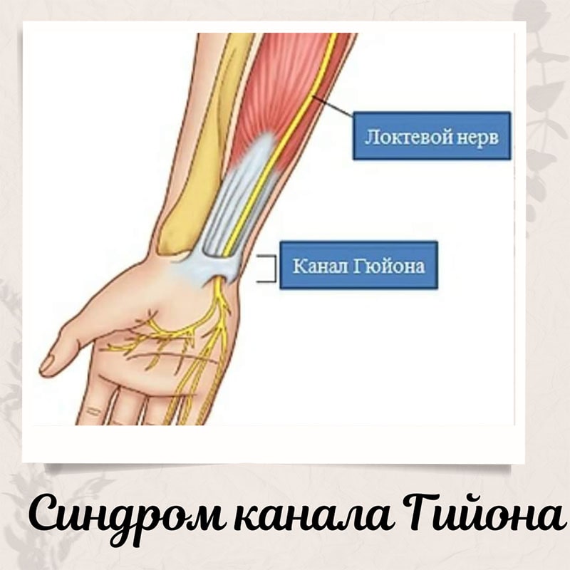 Синдром каналу Гійона