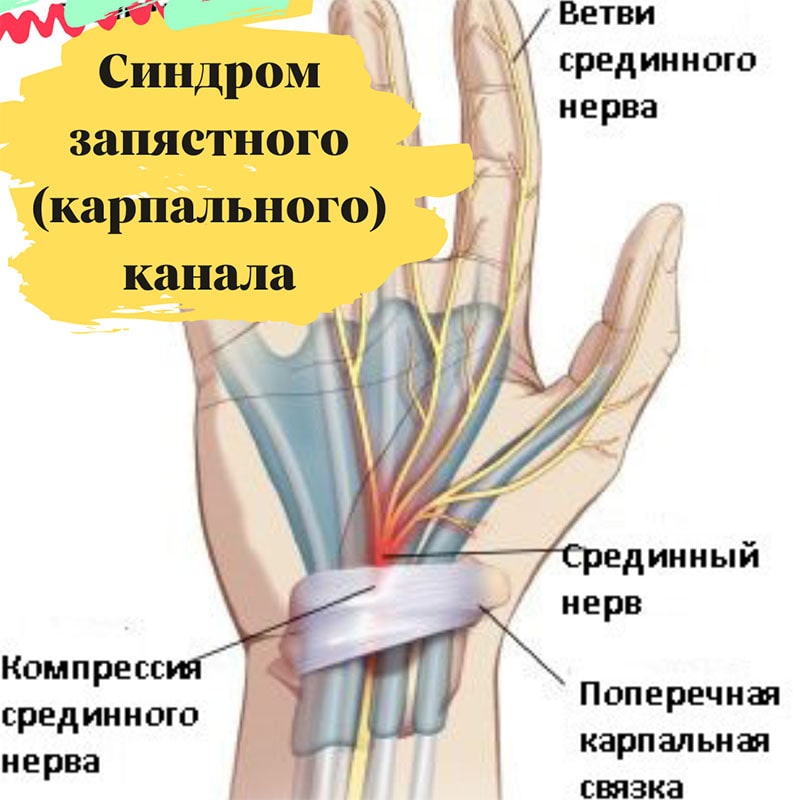 Синдром запястного (карпального) канала